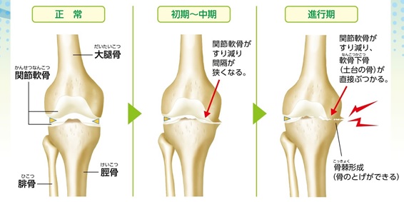 「変形性膝関節症」の画像検索結果