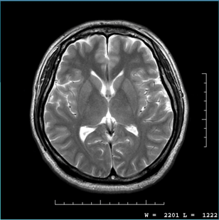 脳MRI1