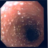 内視鏡：腸7リンパ管拡張症